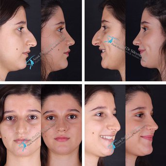 Closed-Rhinoplasty-with-Thick-Skin-Patients